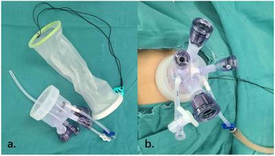 Assessing the learning curve for transumbilical single-site laparoscopy for endometrial cancer